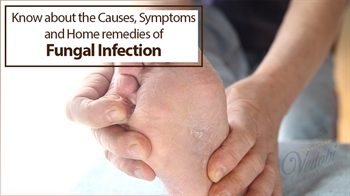 Learn about Fungal Infection, its Causes, Symptoms and Home remedies