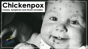 Chickenpox- Causes, Symptoms and Home remedies