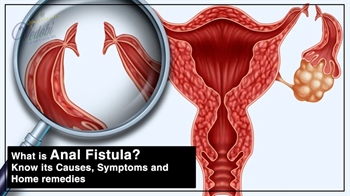 What is Anal Fistula? Know its Causes, Symptoms and Home remedies
