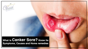 What is Canker Sore? Know its Symptoms, Causes and Home remedies