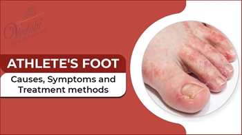 What is Athlete's foot? Know its Causes, Symptoms and Home remedies