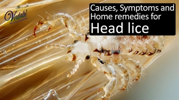 Causes, Symptoms and Home remedies for Head lice