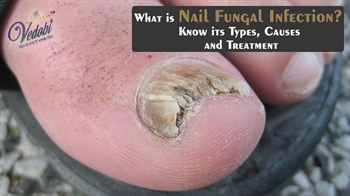 What is Nail Fungal Infection? Know its Types, Causes and Treatment
