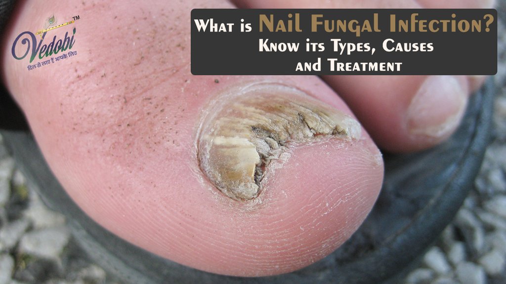 Vedobi - What is Nail Fungal Infection? Know its Types, Causes and Treatment