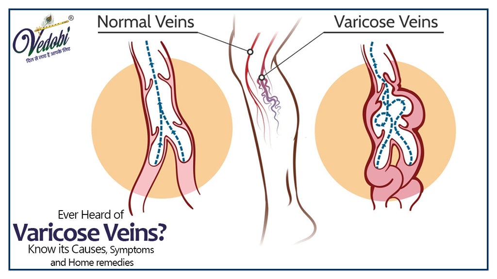 Ever Heard of Varicose Veins? Know its Causes, Symptoms and Home remedies