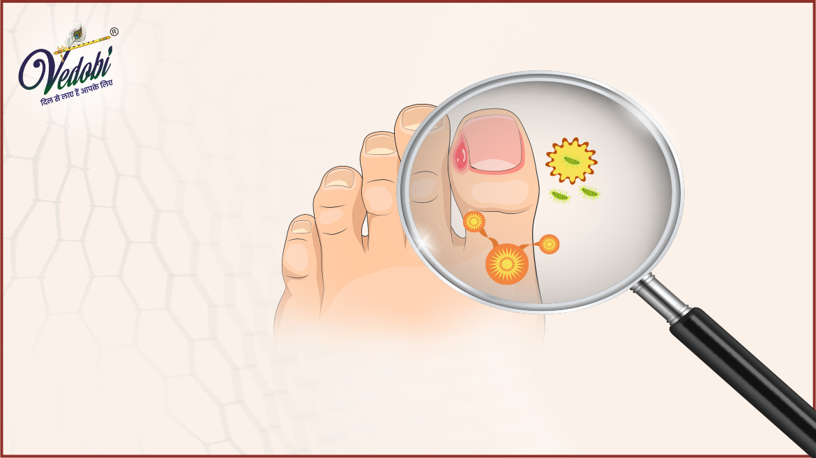 What causes Jock Itch? Know about its Symptoms & Treatment