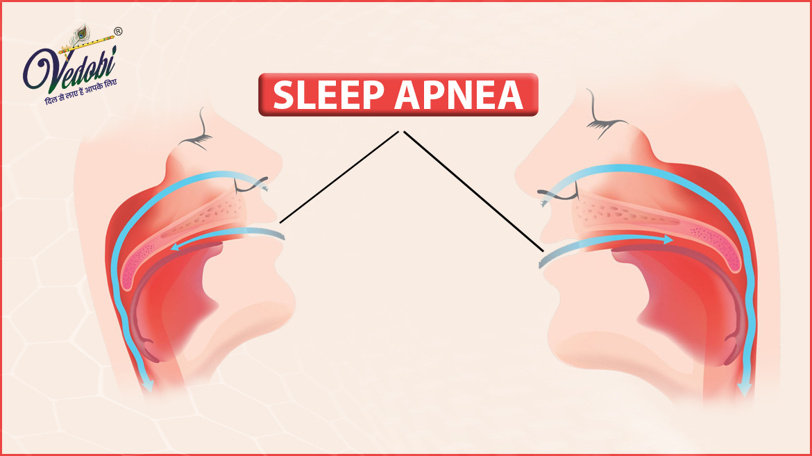 Sleep Apnea: Types, Symptoms, Causes and Treatment
