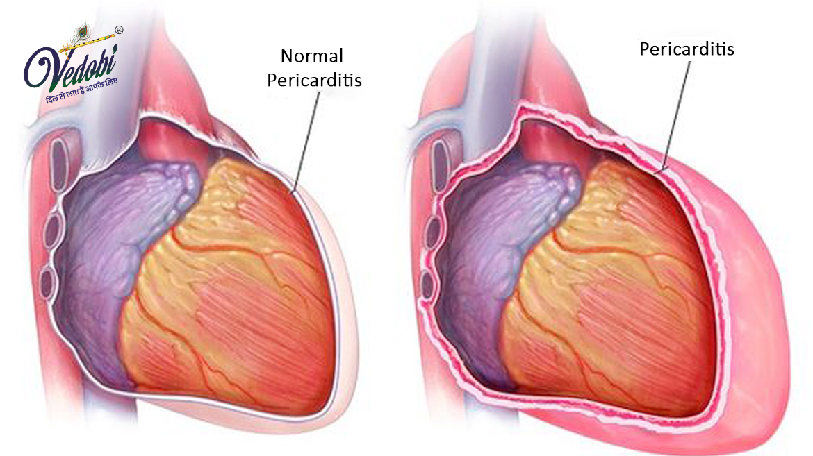 Causes, Symptoms and Treatment of Pericarditis