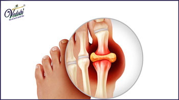 Gout: What is it, Symptoms, Causes and Treatment