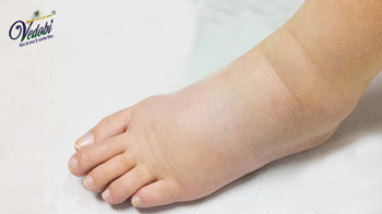 What is Filariasis? Know its Types, Symptoms, Precautions and Treatment methods
