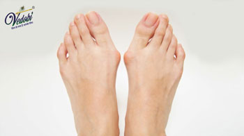 Bunions: Causes, Symptoms and Treatment