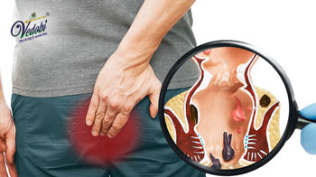 What is Piles (Hemorrhoids)? Know its Types, Causes, Symptoms and Home remedies