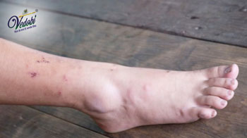 Gangrene Symptoms, Causes, Diagnosis and Treatment