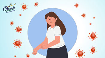 Causes, Symptoms, and Treatment of Measles