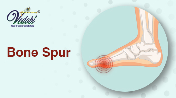 Bone spur- Causes, Symptoms & Treatment methods